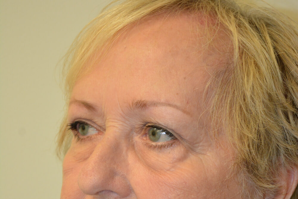 Eyelid-Surgery-14 | After Eyelid Surgery 2