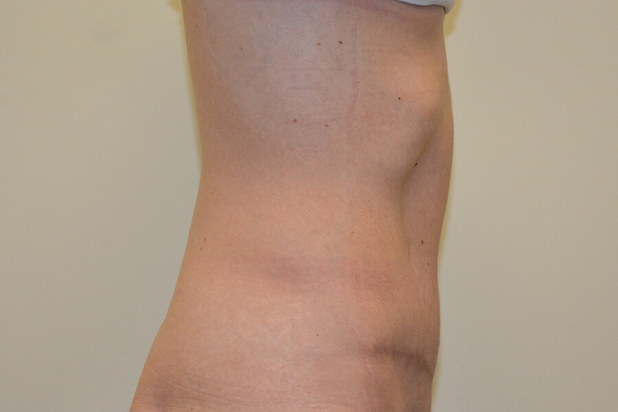 Tummy-Tuck-06 | After Tummy Tuck 3