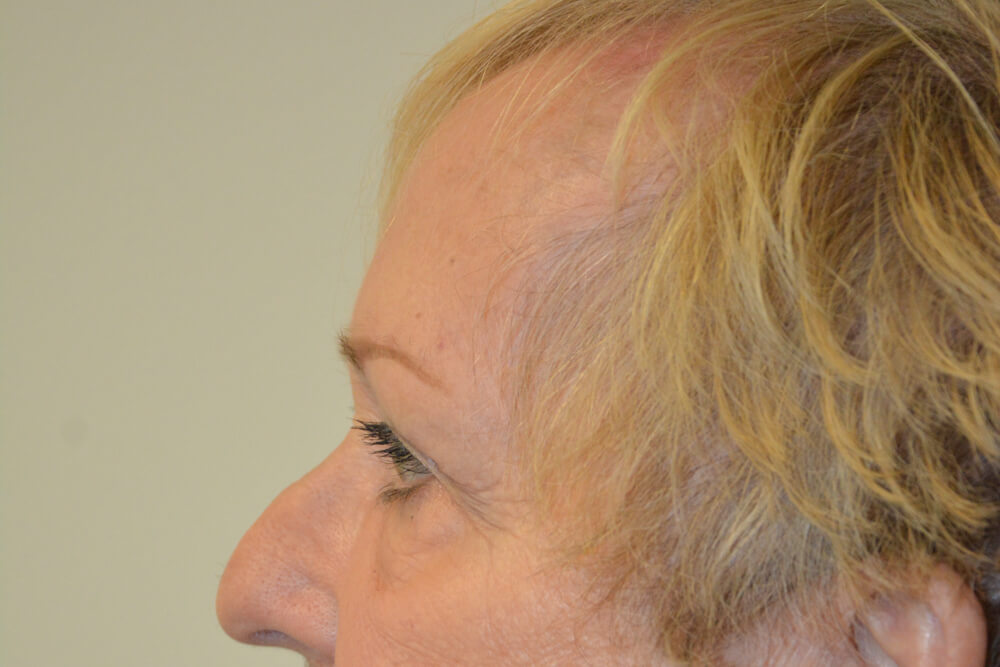 Eyelid-Surgery-14 | After Eyelid Surgery 3
