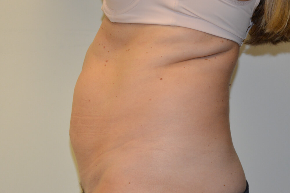Liposuction-11 | Before Liposuction 5