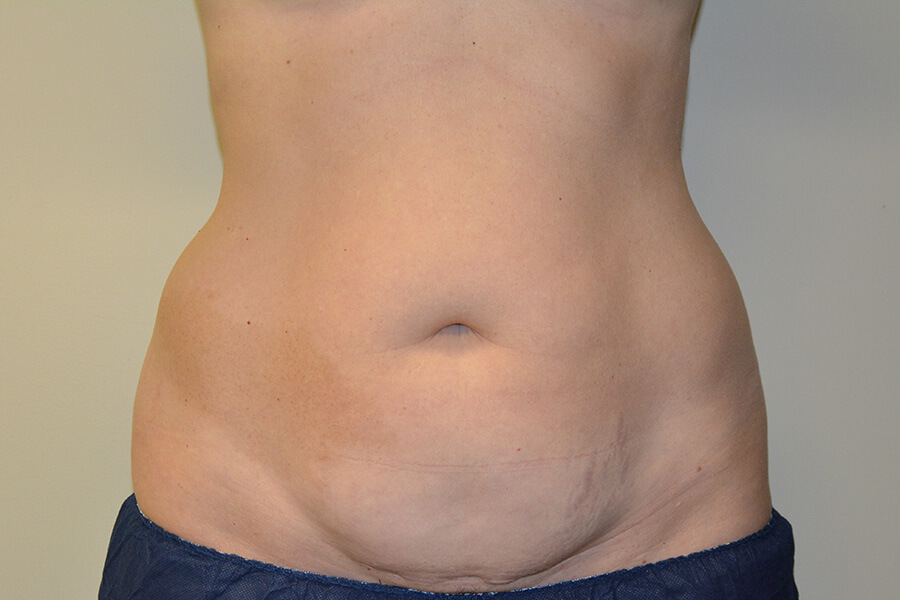 Tummy-Tuck-02 | Before Tummy Tuck