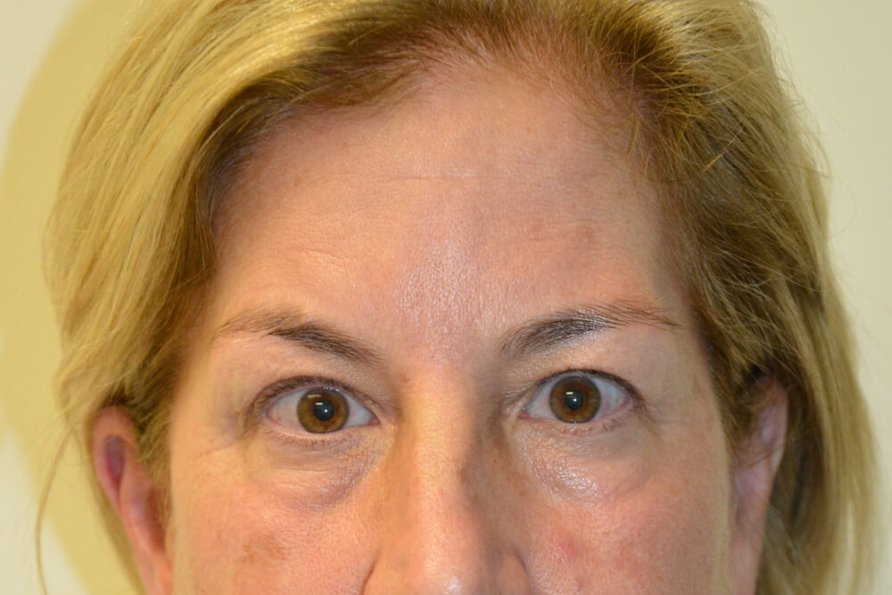 Eyelid-Surgery-15 | Before Eyelid Surgery