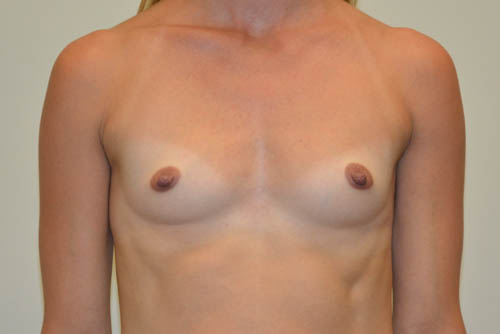 Breast-Augmentation-15 | Before Breast Augmentation 1