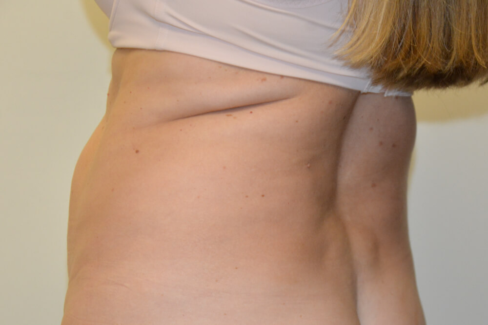 Liposuction-11 | Before Liposuction 4