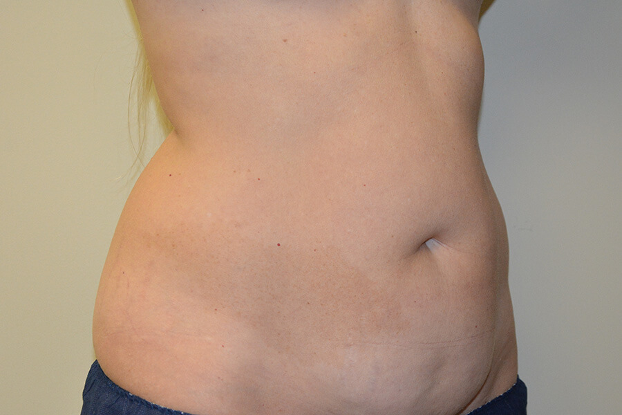 Tummy-Tuck-02 | Before Tummy Tuck 2
