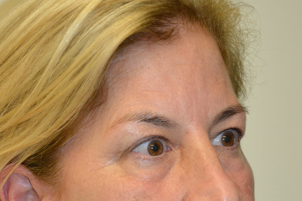 Eyelid-Surgery-15 | Before Eyelid Surgery 2