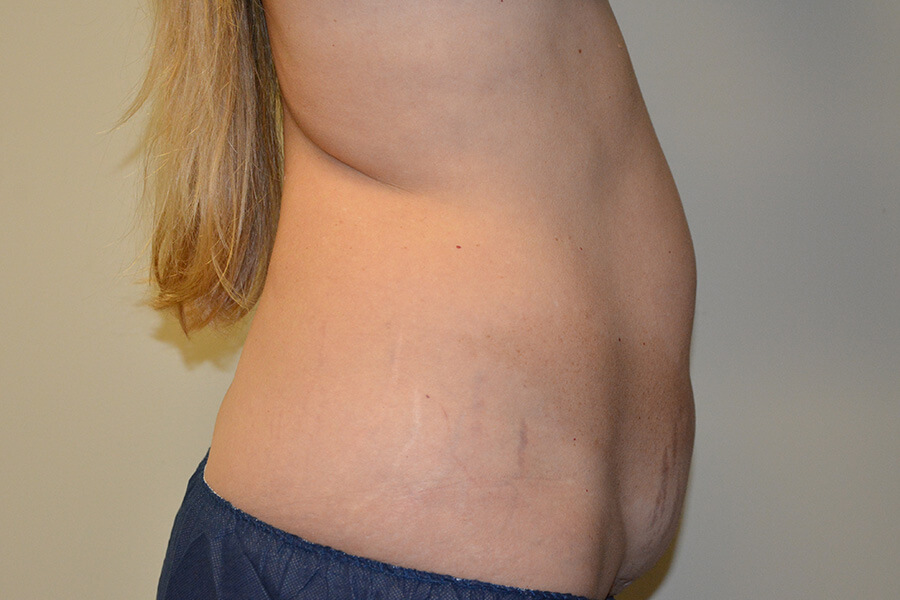 Tummy-Tuck-02 | Before Tummy Tuck 3
