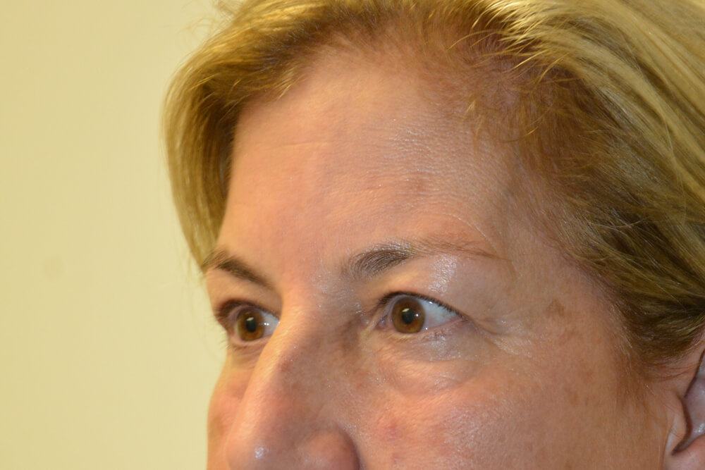 Eyelid-Surgery-15 | Before Eyelid Surgery 4
