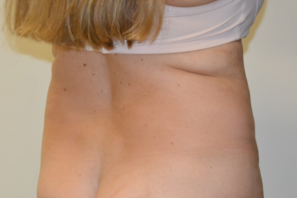 Liposuction-11 | Before Liposuction 2
