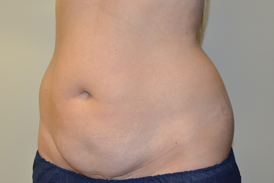 Tummy-Tuck-02 | Before Tummy Tuck 4
