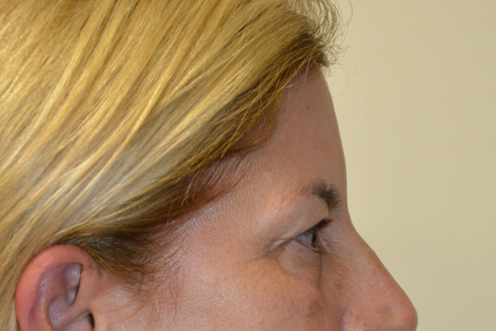 Eyelid-Surgery-15 | Before Eyelid Surgery 3
