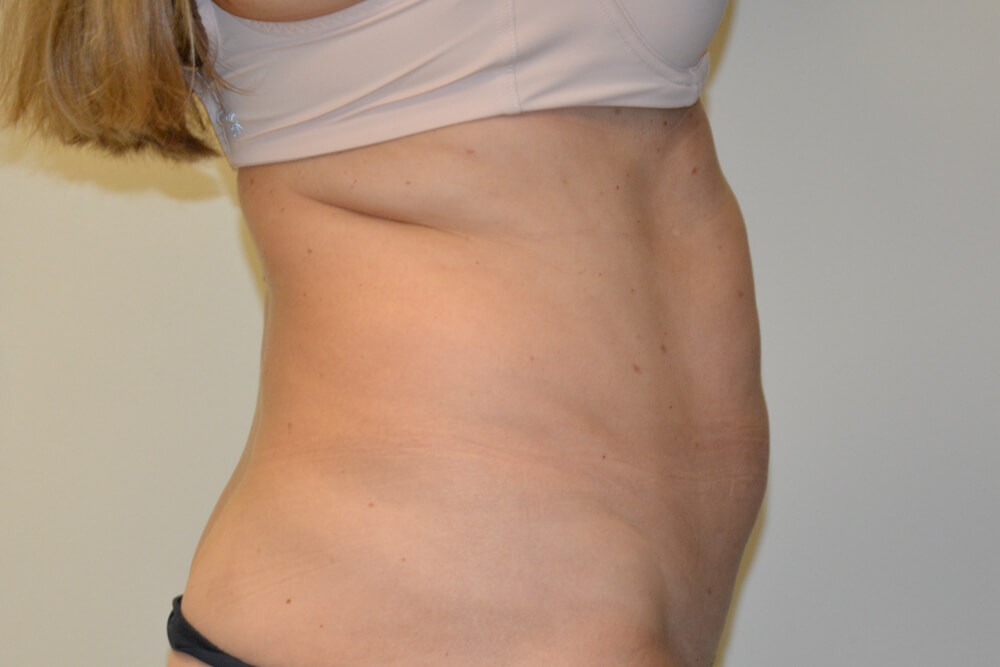 Liposuction-11 | Before Liposuction 3