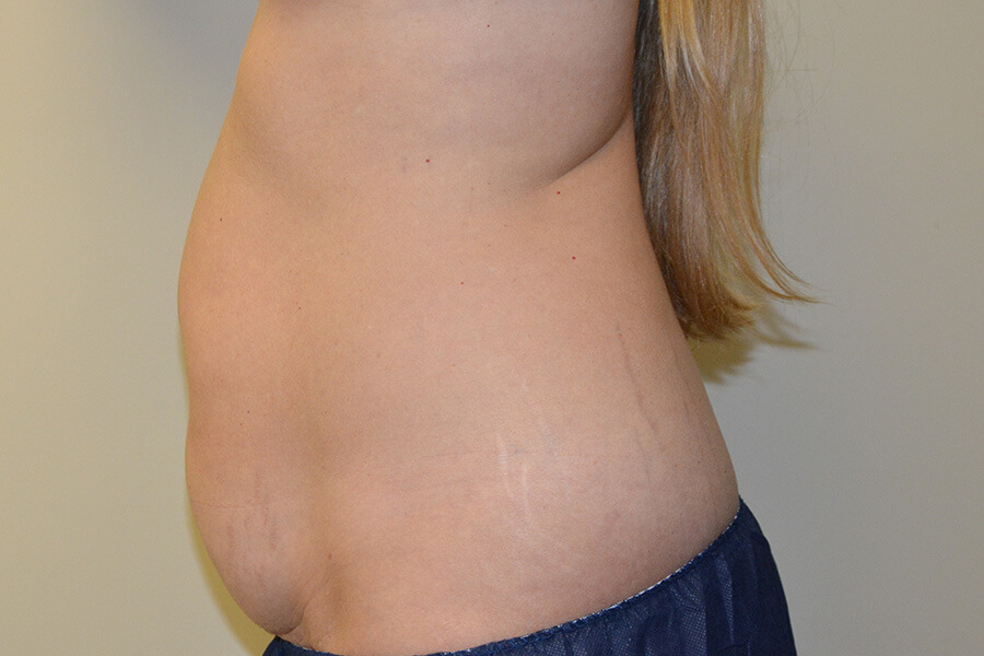 Tummy-Tuck-02 | Before Tummy Tuck 5