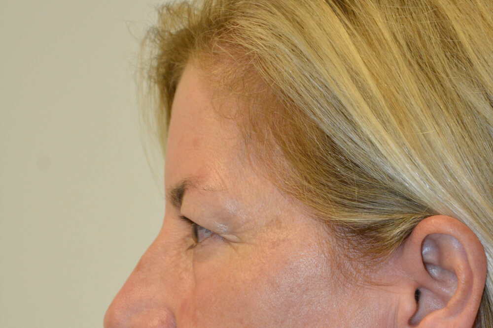 Eyelid-Surgery-15 | Before Eyelid Surgery 5