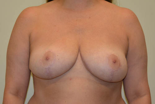 Breast-Reduction-15 | After Breast Reduction