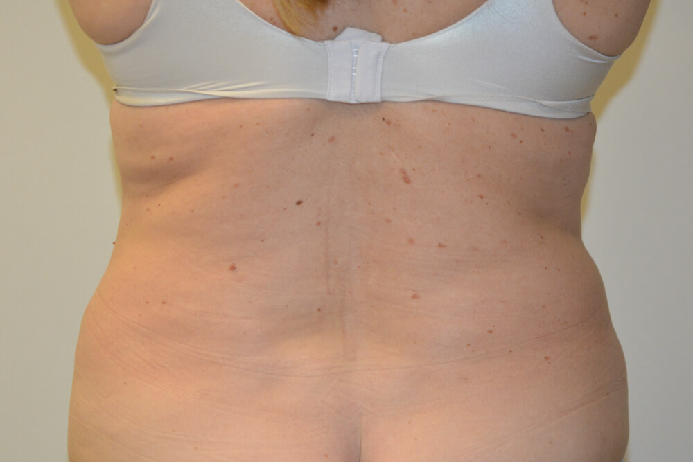 Liposuction-11 | After Liposuction
