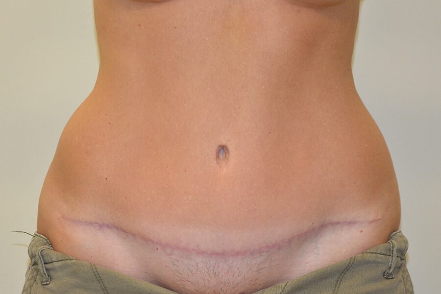 Tummy-Tuck-02 | After Tummy Tuck