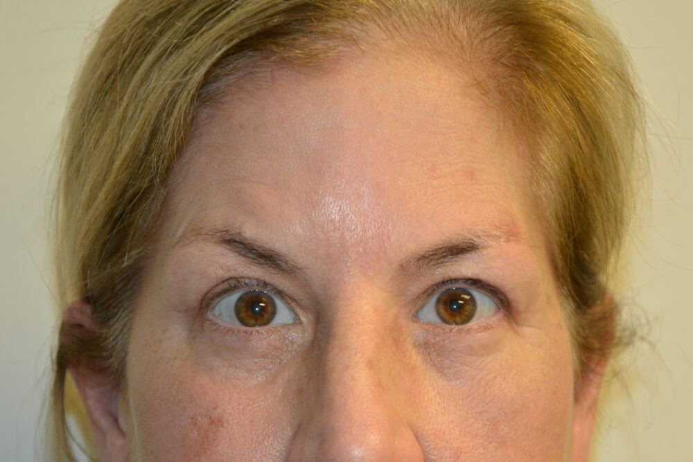Eyelid-Surgery-15 | After Eyelid Surgery