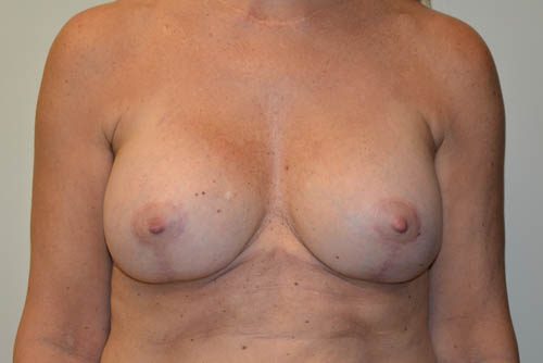 Breast-Revision-15 | After Breast Revision