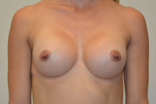 Breast-Augmentation-15 | After Breast Augmentation 1