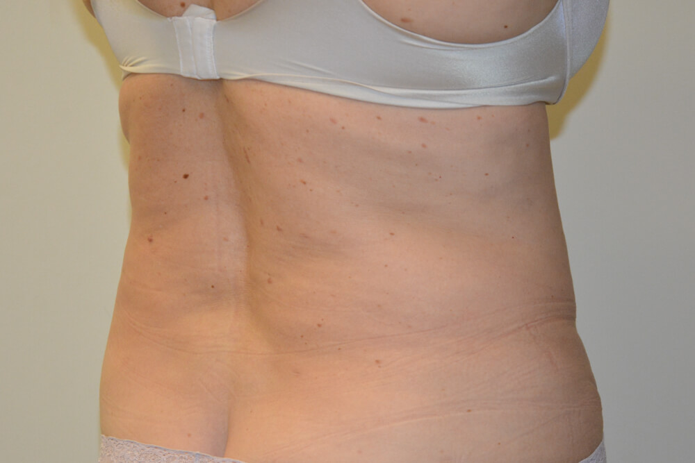 Liposuction-11 | After Liposuction 2