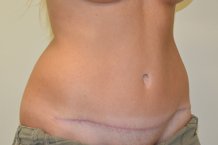 Tummy-Tuck-02 | After Tummy Tuck 2