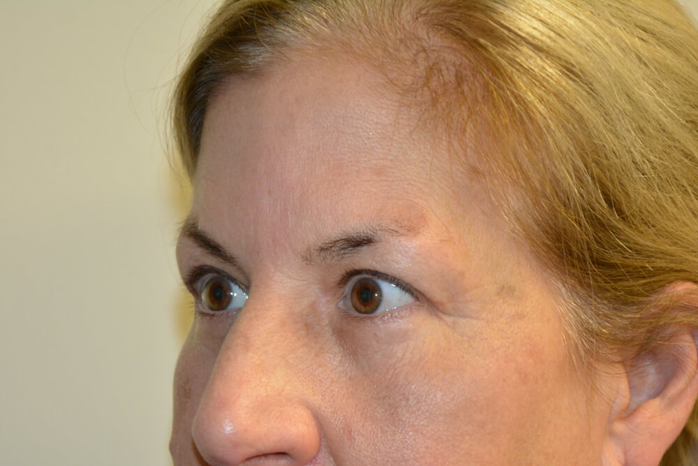 Eyelid-Surgery-15 | After Eyelid Surgery 4