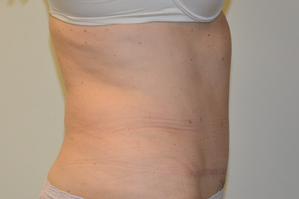 Liposuction-11 | After Liposuction 3