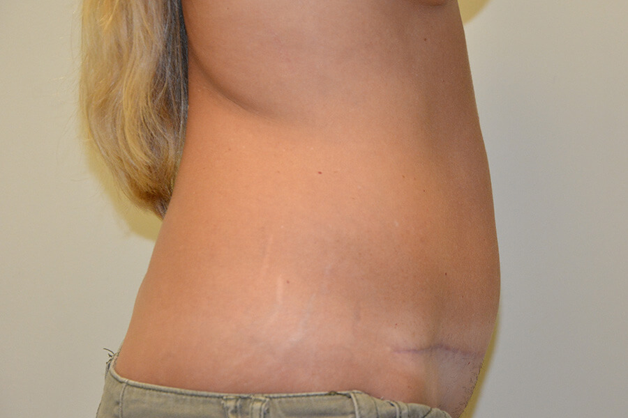 Tummy-Tuck-02 | After Tummy Tuck 3