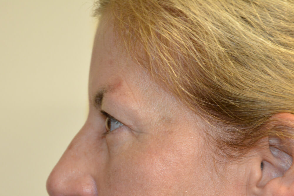 Eyelid-Surgery-15 | After Eyelid Surgery 5