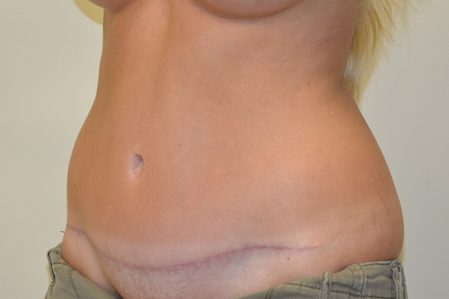 Tummy-Tuck-02 | After Tummy Tuck 4