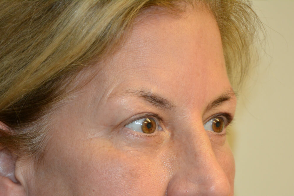 Eyelid-Surgery-15 | After Eyelid Surgery 2