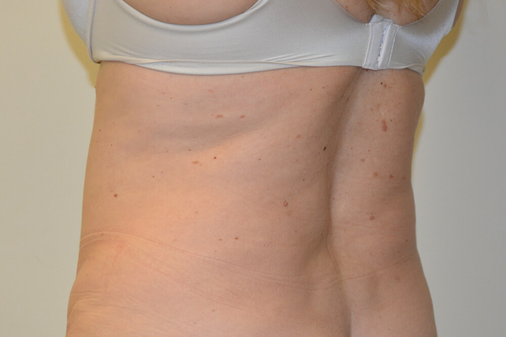 Liposuction-11 | After Liposuction 4