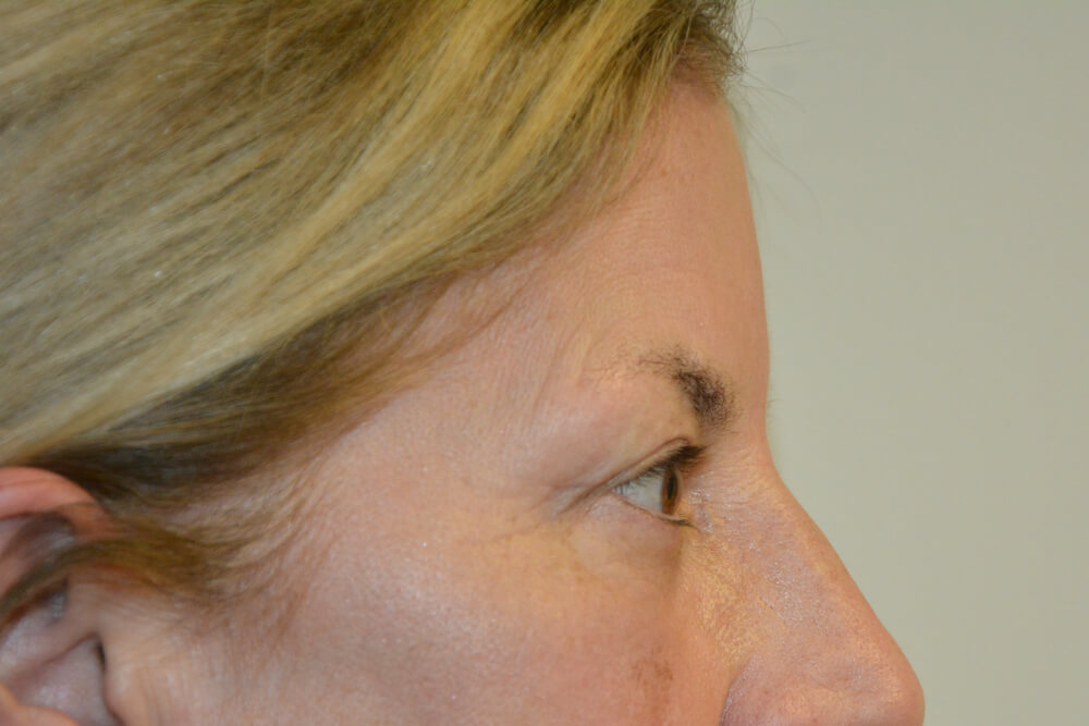 Eyelid-Surgery-15 | After Eyelid Surgery 3