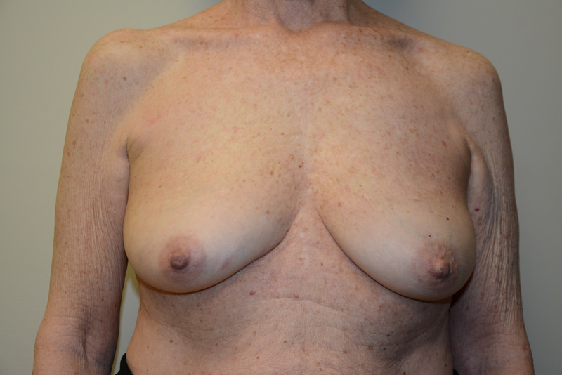 Breast-Reconstruction-Tissue-Expanders-16 | Before Breast Reconstruction Tissue Expanders