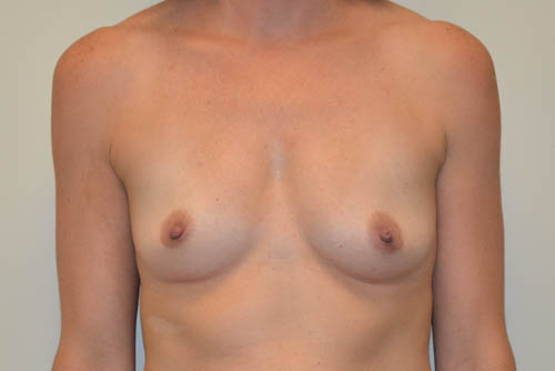 Breast-Augmentation-16 | Before Breast Augmentation