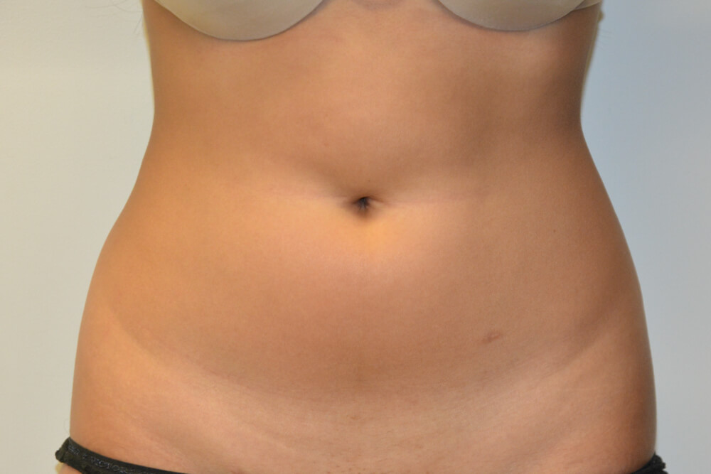 Liposuction-10 | Before Liposuction