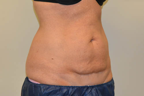 Tummy-Tuck-16 | Before Tummy Tuck 2