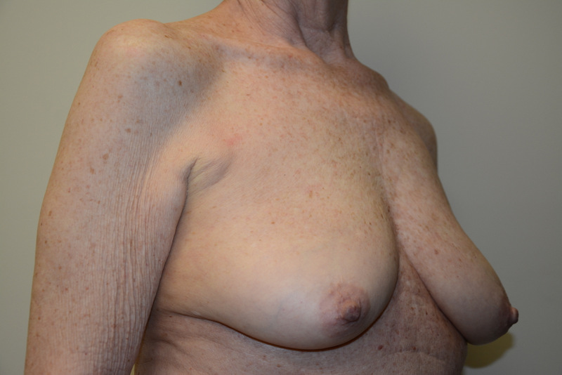 Breast-Reconstruction-Tissue-Expanders-16 | Before Breast Reconstruction Tissue Expanders 2