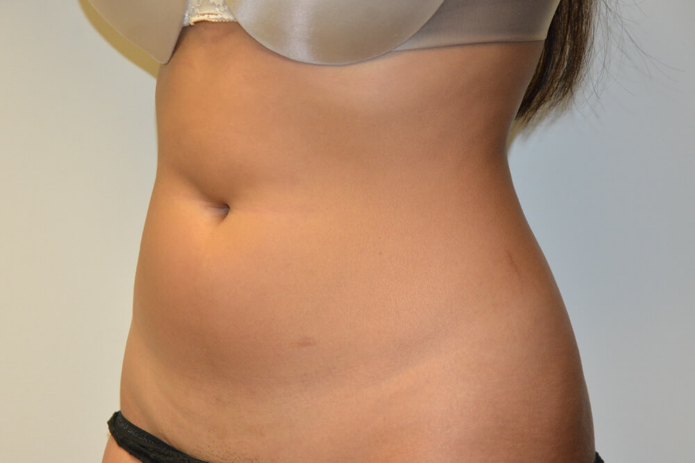 Liposuction-10 | Before Liposuction 2