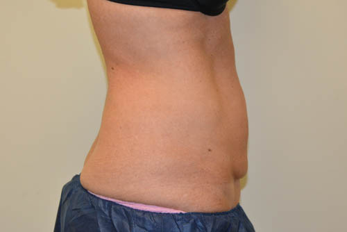 Tummy-Tuck-16 | Before Tummy Tuck 3