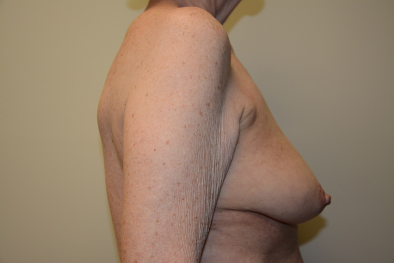 Breast-Reconstruction-Tissue-Expanders-16 | Before Breast Reconstruction Tissue Expanders 3
