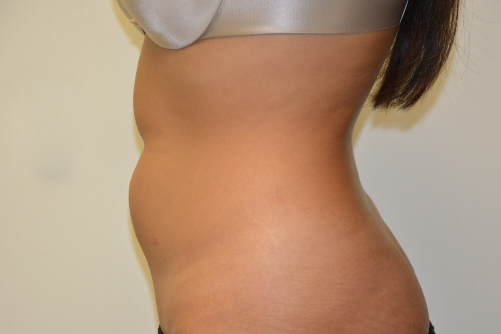Liposuction-10 | Before Liposuction 3