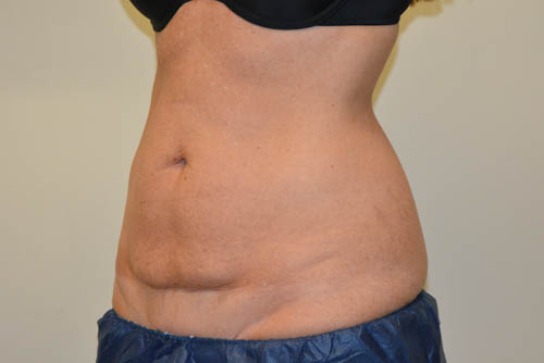 Tummy-Tuck-16 | Before Tummy Tuck 4