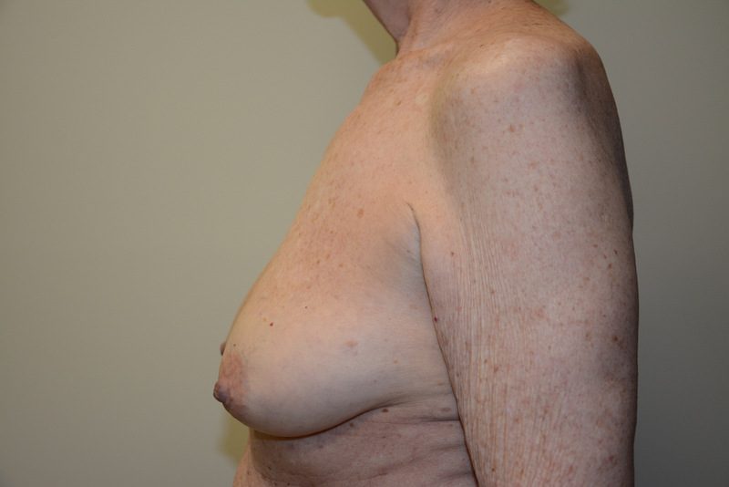Breast-Reconstruction-Tissue-Expanders-16 | Before Breast Reconstruction Tissue Expanders 4