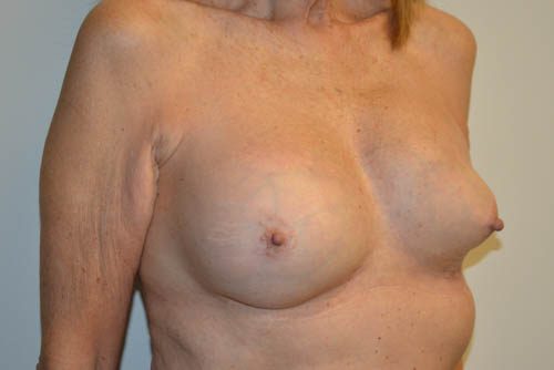 Breast-Revision-16 | Before Breast Revision 4