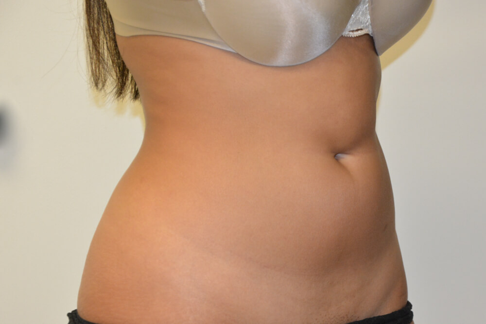 Liposuction-10 | Before Liposuction 4
