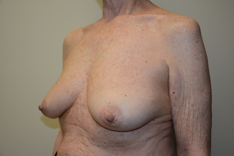 Breast-Reconstruction-Tissue-Expanders-16 | Before Breast Reconstruction Tissue Expanders 5