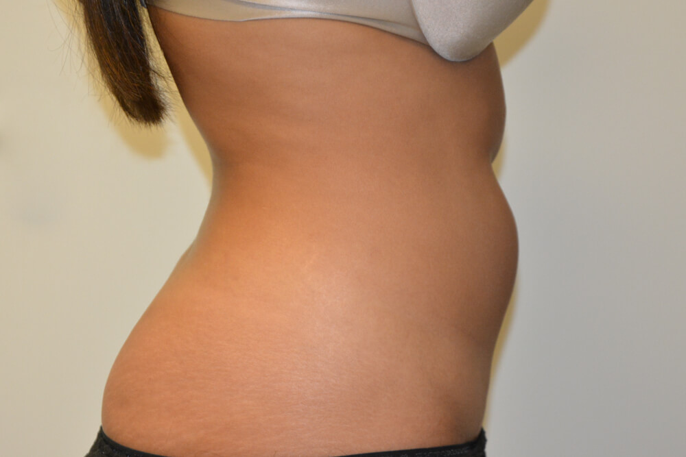 Liposuction-10 | Before Liposuction 5
