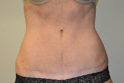 Tummy-Tuck-16 | After Tummy Tuck